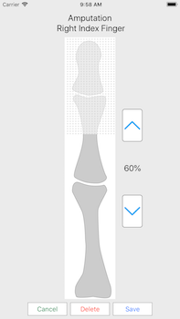 finger amputation screen shot
